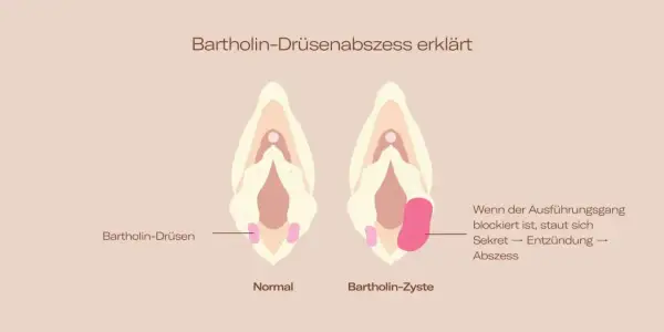 Vergleich von normaler Bartholin-Drüse und Bartholin-Zyste/Abszess im Intimbereich. Zeigt, wie Sekretstau zu Entzündung und Abszess führt.
