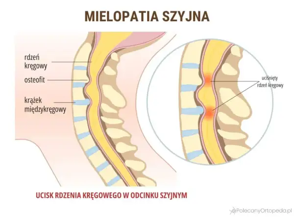 Ucisk na rdzeń kręgowy w odcinku szyjnym, prowadzący do mielopatii i potencjalnego drętwienia barku. Widoczne osteofity i krążki międzykręgowe.
