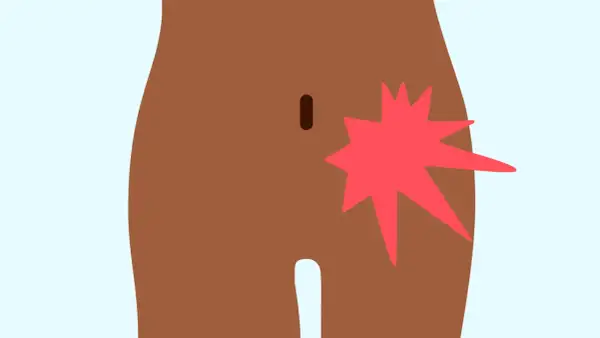 Illustration d'une zone du corps humain montrant une douleur vive au pubis côté droit, symbolisée par une étoile rouge éclatante.
