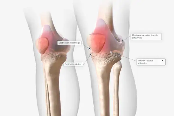 Comparaison de genoux : un sain et un affecté par la polyarthrite rhumatoïde, montrant la destruction du cartilage, de l'os et l'épaississement de la membrane synoviale.