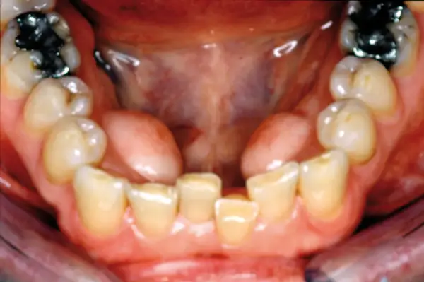Vista ravvicinata della bocca con denti inferiori e superiori visibili. Si nota un toro palatino, una protuberanza ossea sul palato.