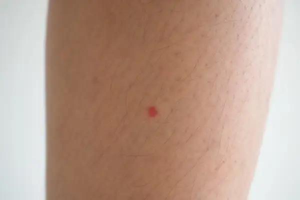 Una pequeña mancha roja en la pierna, quizás una picadura de insecto, resalta sobre la piel con vello.