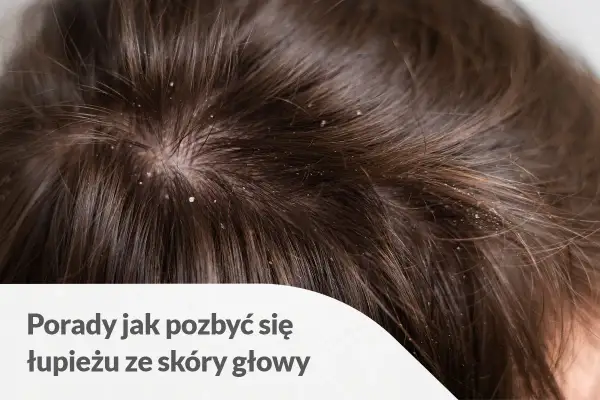 Widoczny łupież na czubku głowy, wśród ciemnych włosów. Białe płatki osiadły na skórze i włosach, tworząc nieestetyczny widok.