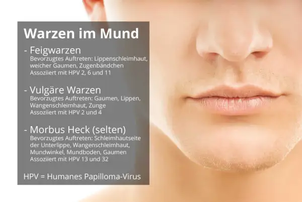 Informationen zu HPV im Mund: Feig-, vulgäre und Morbus Heck-Warzen. Erfahren Sie mehr über die Ursachen und Symptome.