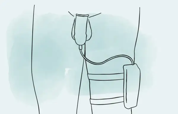Illustration zeigt, wie man ein Urinalkondom anlegt. Ein Schlauch verbindet das Kondom mit einem Auffangbeutel am Bein.