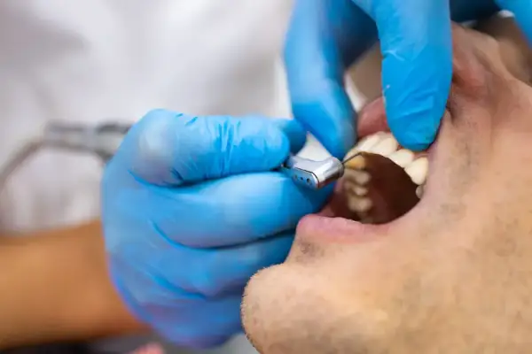 Dentysta w niebieskich rękawiczkach używa wiertła stomatologicznego do leczenia zęba, który może być dotknięty zatruciem.