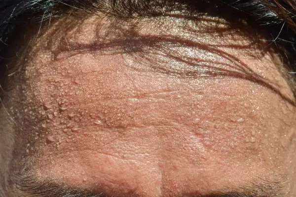 Frente sudorosa, con gotas de agua brillando. Busca trucos para no sudar por la cabeza y mantenerte fresco.