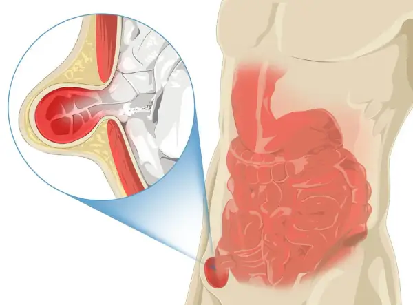 Hernie inguinale chez l'homme : une partie de l'intestin sort par une faiblesse de la paroi abdominale, près du pubis.