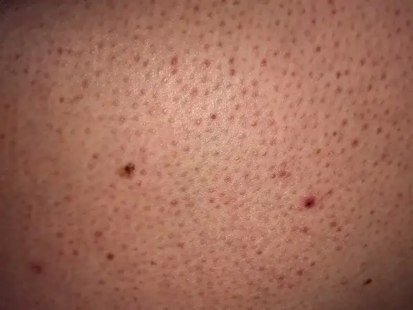 Widoczne liczne drobne krostki na ramionach, niektóre zaczerwienione, tworzące teksturę skóry.