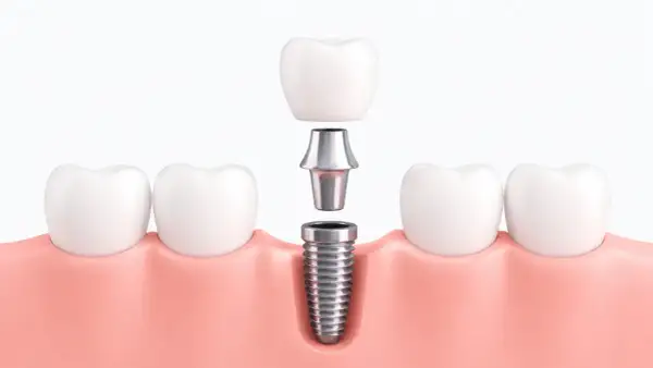 Componentes de un implante dental: tornillo, pilar y corona, listos para ser ensamblados en la encía.