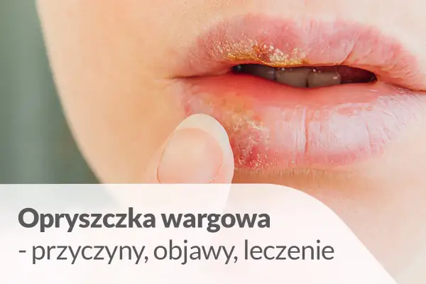 Zbliżenie na usta z widocznym początkiem opryszczki wargowej. Palec wskazujący dotyka zaczerwienionego miejsca.