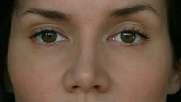 Oczy kobiety z lekko opadającą powieką, rozważającej zabieg botox.