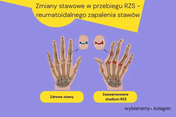 Porównanie zdrowych stawów dłoni z zaawansowanym stadium RZS, gdzie widoczne są zmiany zapalne i uszkodzenia kości.