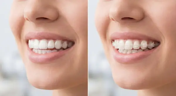 Primo piano di un sorriso con apparecchio trasparente e poi con apparecchio fisso.