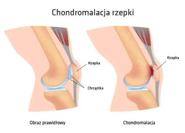 Ilustracja porównująca prawidłowe kolano z kolanem z chondromalacją rzepki.