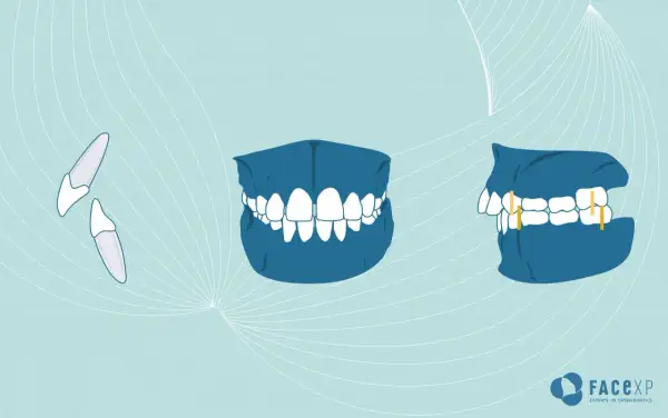 Illustrazione di denti sporgenti, prima e dopo il trattamento ortodontico.