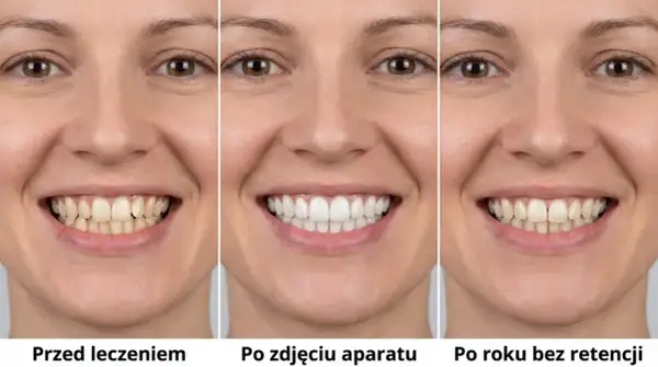 Uśmiech przed leczeniem, po zdjęciu aparatu stałego i po roku bez retencji. Widać znaczącą poprawę.