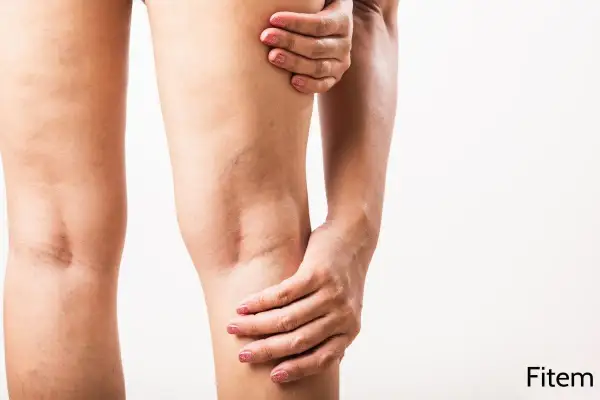 Une femme se tient la jambe, ressentant une courbature. Des varicosités sont visibles sur sa peau.