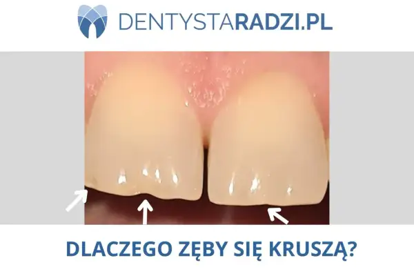 Zbliżenie na dwa zęby z widocznymi ubytkami na krawędziach, wskazującymi na ukruszone szkliwo. Strzałki podkreślają problem.