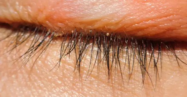 Nahaufnahme des menschlichen Augenlids mit Wimpern. Kleine, helle Punkte, die wie Milben am Auge aussehen, sind auf den Wimpern und der Haut sichtbar.