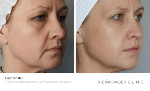 Przed i po zabiegu lipotransferu. Widoczne wygładzenie skóry i przywrócenie objętości twarzy.
