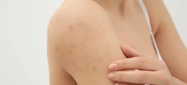Widoczne grudki pod skórą na ramieniu, które mogą być objawem problemów dermatologicznych.