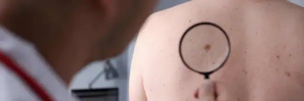 Dermatolog bada znamiona barwnikowe na plecach pacjenta za pomocą lupy.