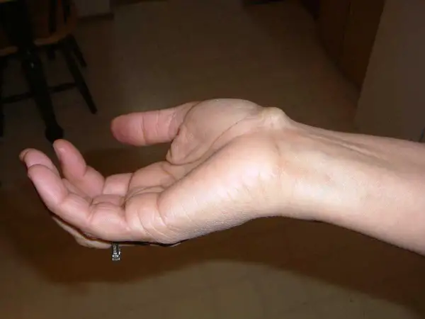 Poignet gauche avec un kyste synovial visible. Témoignages sur le kyste synovial poignet.