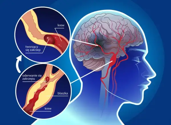 PFO objawy neurologiczne: Jak unikać ryzyka udaru mózgu?