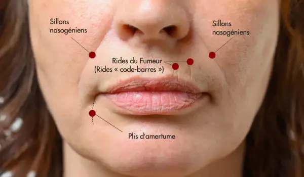 Gros plan sur le visage d'une femme, montrant les sillons nasogéniens, les rides du fumeur autour des lèvres et les plis d'amertume.