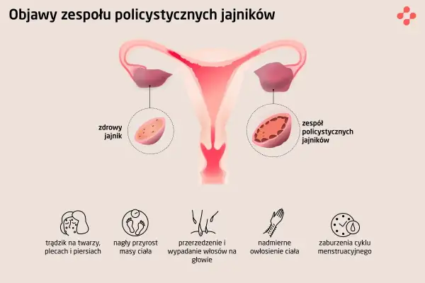Ilustracja pokazuje budowę macicy i jajników, porównując zdrowy jajnik z tym dotkniętym PCOS. Widoczne są objawy: trądzik, przyrost masy ciała, wypadanie włosów, nadmierne owłosienie i zaburzenia cyklu.