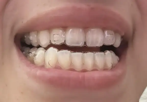 Denti con Invisalign, pronti per mangiare uno yogurt cremoso.