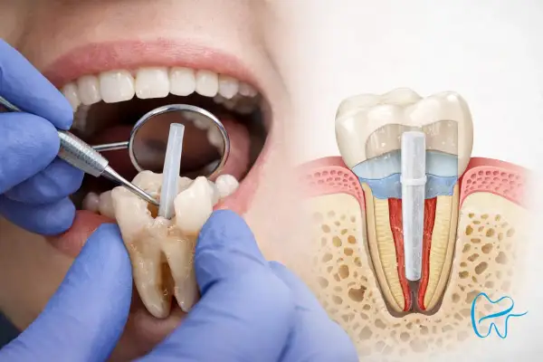 Dentysta wprowadza wkład koronowo-korzeniowy. Czy odbudowa zęba boli? Nowoczesne metody minimalizują dyskomfort.