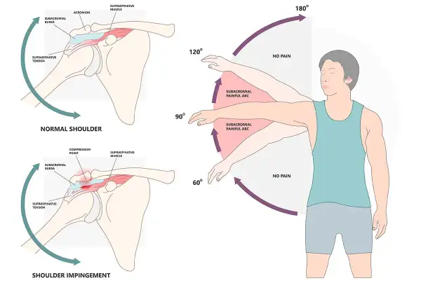 Schulter-Impingement-Syndrom: Schmerzhafter Bogen bei Armhebung zwischen 60° und 120°. Normale Schulter ohne Schmerz.
