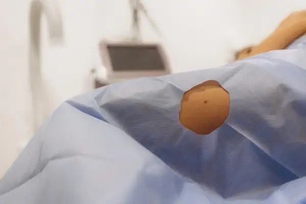 Skóra pacjenta przygotowana do zabiegu dermatochirurgii. W tle sprzęt medyczny.