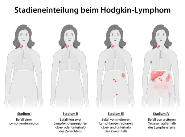 Illustrationen zeigen Stadien des Hodgkin-Lymphoms, von einem einzelnen befallenen Lymphknoten bis zu Befall mehrerer Organe. Symptome Lymphknotenkrebs können sich je nach Stadium ändern.