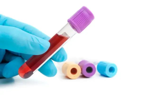 Ręka w niebieskiej rękawiczce trzyma probówkę z krwią. W tle inne probówki. Badanie hemoglobiny glikowanej - norma.