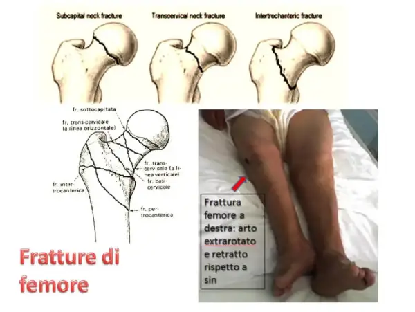 Illustrazione tipi frattura femore e gamba con frattura. La prognosi e quanto si vive dopo frattura femore dipendono da molti fattori.