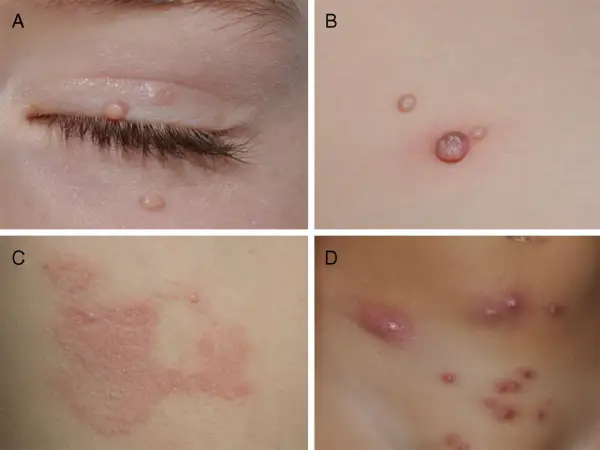 Lesiones de molusco contagioso en la piel de niños. A: párpado. B: tronco. C: tronco con inflamación. D: abdomen.