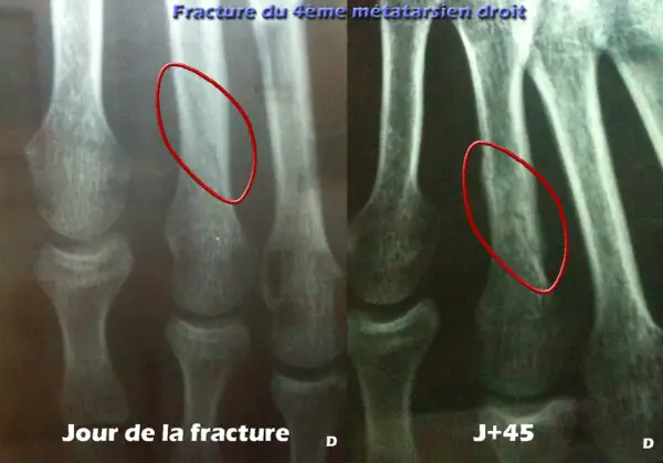 Radiographie du pied montrant une fracture du 4ème métatarsien droit, jour de la fracture et J+45. La guérison prend du temps.