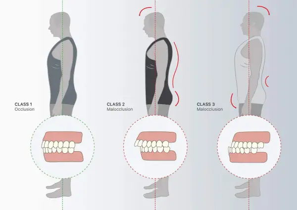Classi di occlusione dentale: 1 (normale), 2 (malocclusione) e 3 (malocclusione), con profili posturali associati.