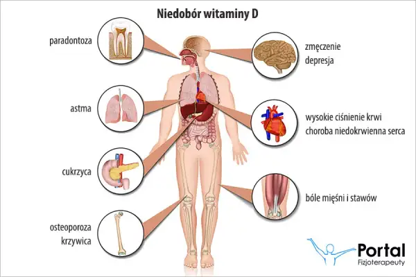 Niedobór witaminy D: 20 objawów, których nie wolno ignorować!