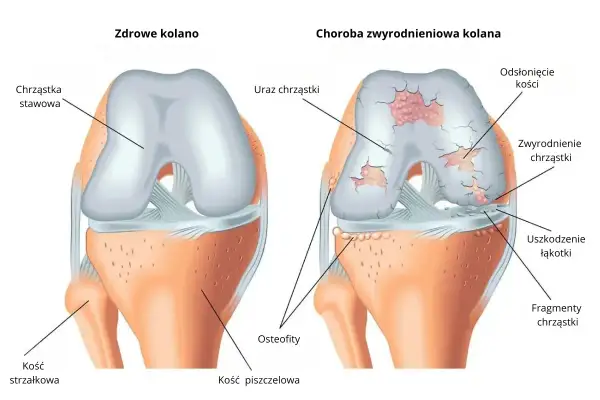 Porównanie zdrowego kolana z kolanem ze zwyrodnieniem, pokazujące uszkodzenia chrząstki i kości.