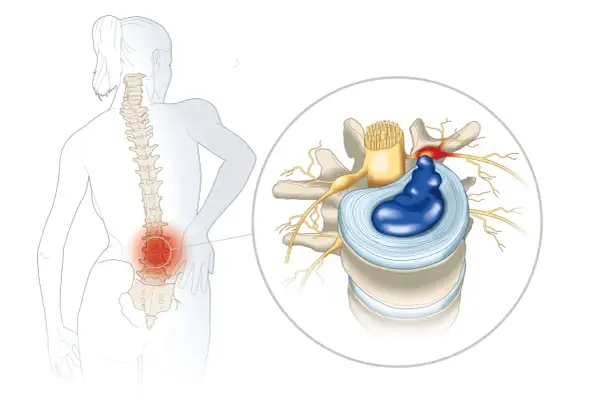 Illustration d'une discopathie lombaire causant une douleur la nuit, avec un disque intervertébral hernié comprimant un nerf.