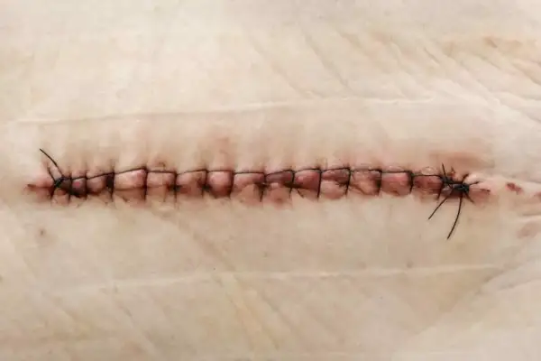 Gros plan d'une plaie suturée, où un fil de suture reste dans la plaie, témoignant du processus de guérison.