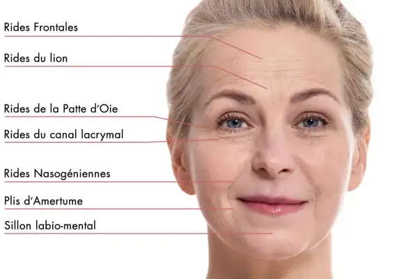 Visage d'une femme montrant les rides frontales, du lion, pattes d'oie, nasogéniennes, plis d'amertume et sillon labio-mental.