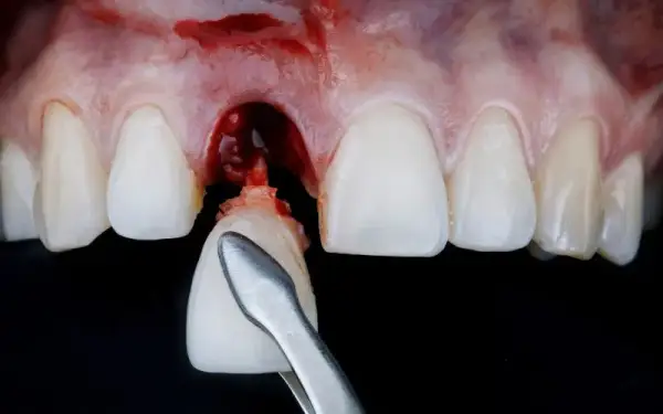 Krwawienie po wyrwaniu zęba: co jest normą, a kiedy do dentysty?