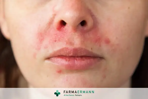 Primo piano del volto di una persona con arrossamenti e piccole pustole, indicativi di dermatite faccia.