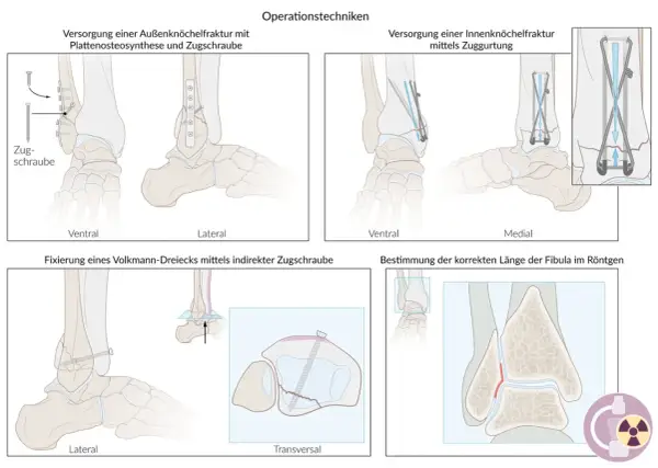 Fixierung eines Volkmann-Dreiecks mit indirekter Zugschraube am Sprunggelenk. Illustration zeigt die laterale und transversale Ansicht.