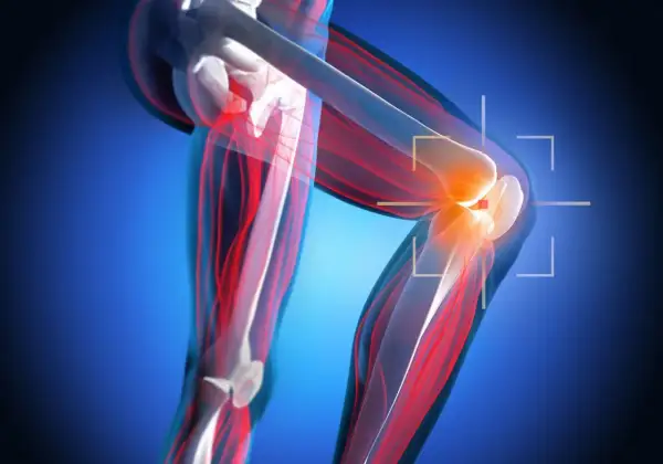 Anatomia kolana z zaznaczonym bólem, sugerującym nieleczone zerwane więzadło krzyżowe. Czerwone linie wskazują na uszkodzone tkanki.